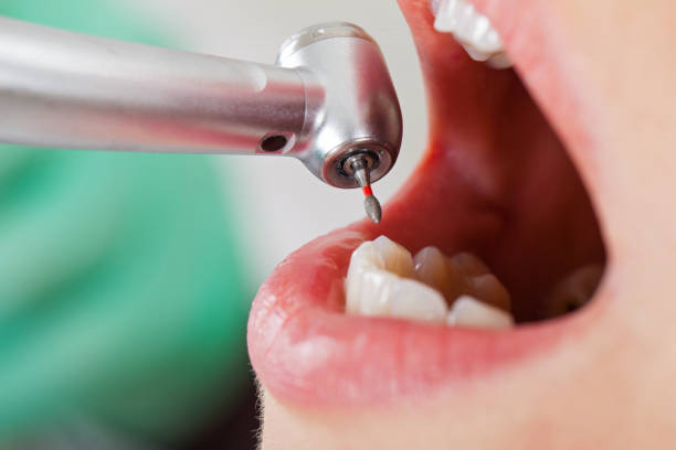 Best Emergency Dentist for Lost Fillings or Crowns in Schlusser, PA